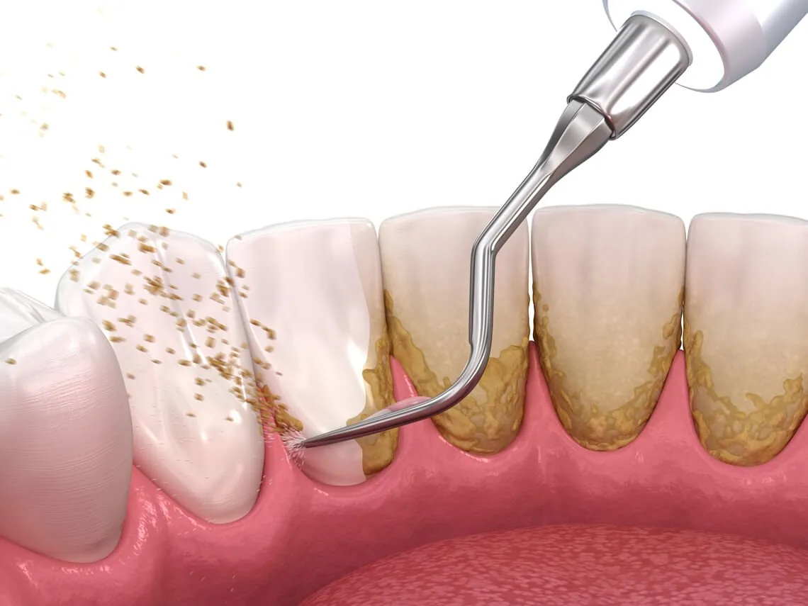 Benefícios da Limpeza de Dentes Regular